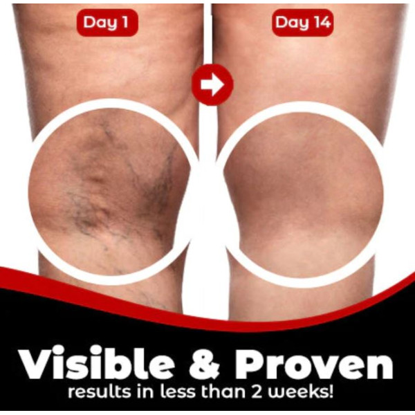 Пластири за разширени вени Varicose Care 12 броя